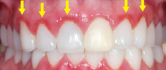 Fuente: http://www.blognews.midentista-mrc.com/enfermedad-periodontal/ 